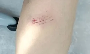 Bỗng dưng bị chó cắn